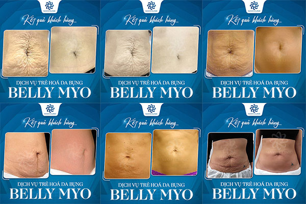 Hình ảnh kết quả khách hàng Trẻ hóa da bụng Belly Myo