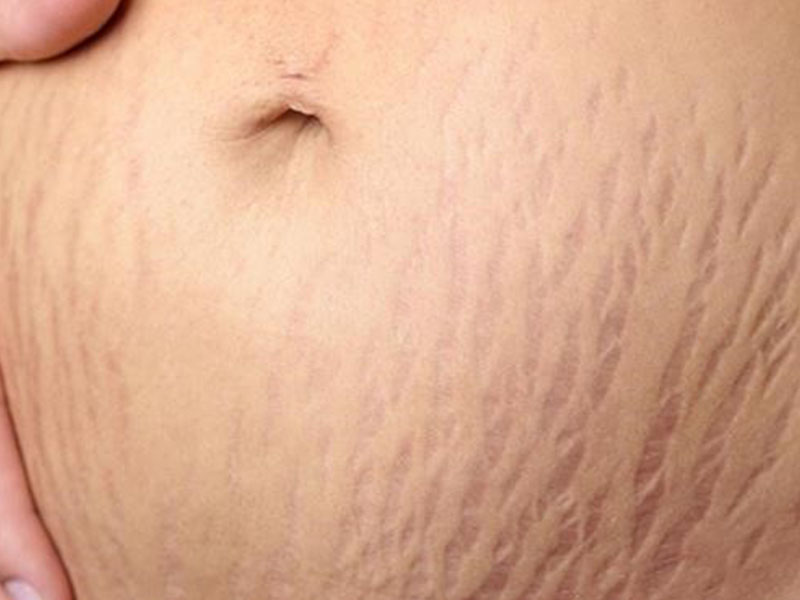 Rạn bụng sau sinh là tình trạng khi da bụng bị kéo căng quá mức