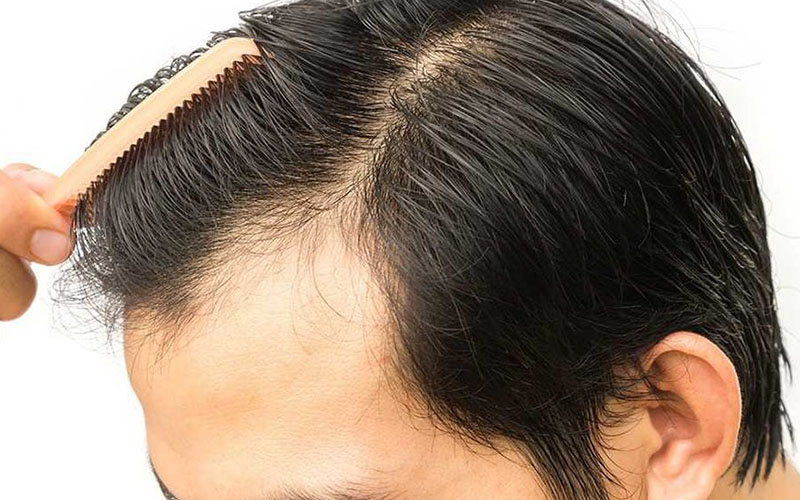 Lưu ý chăm sóc da đầu sau khi cấy tóc giúp ít đau
