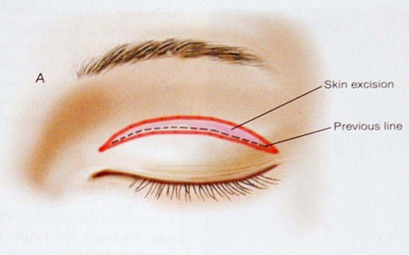 Cắt mí mắt có hại đến sức khỏe và thị lực không?