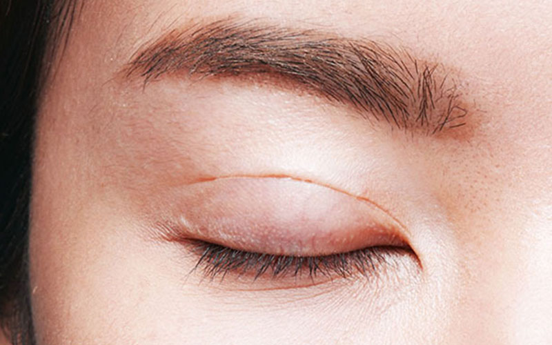 Cắt mắt 2 mí có thể gây tác hại gì cho sức khỏe
