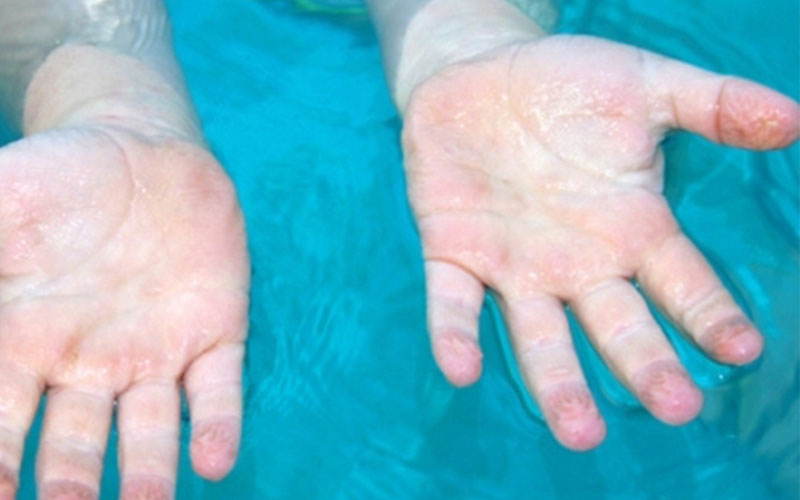 Tác dụng của nếp nhăn trên da tay khi gặp nước